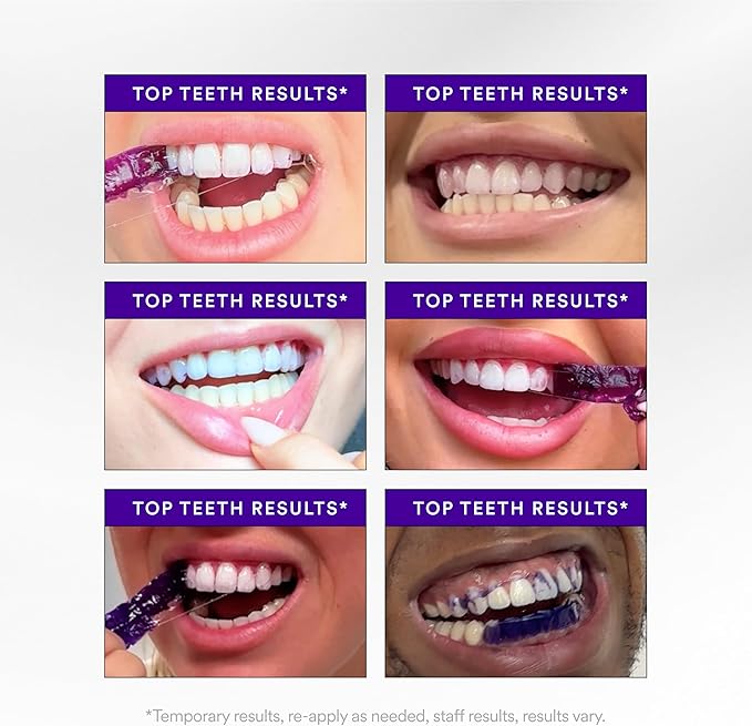 V34 Teeth Whitening Strips — view 3