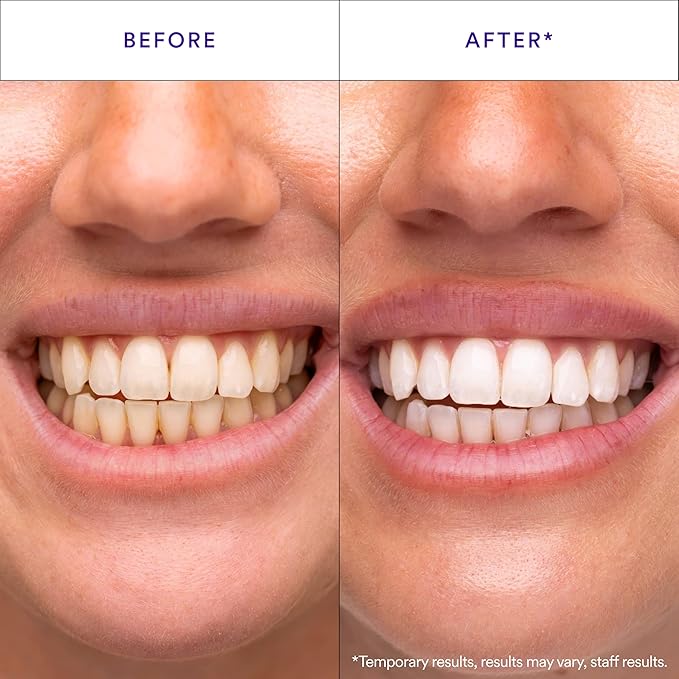 V34 Teeth Whitening Strips — view 2