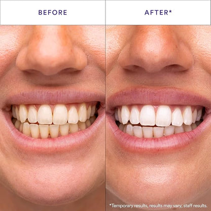 V34 Teeth Whitening Strips — view 2
